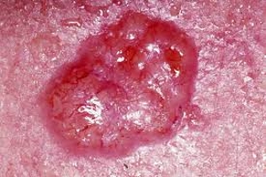 Basal Cell Carcinoma Skin Cancer