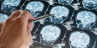 Know About Brain Cancer