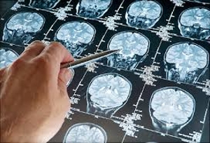 Know About Brain Cancer