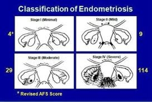 Stages of Endometriosis