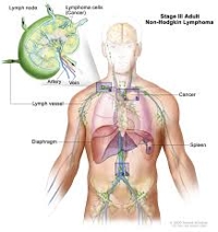 lymph nodes cancer