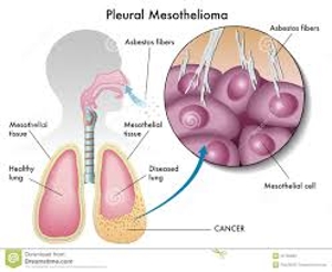 About Pleural Mesothelioma