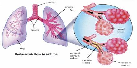 Asthma Chronic Disease: Symptoms and Causes - Assignment Point