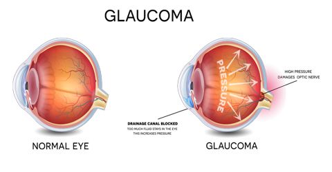 How to Prevent Glaucoma?