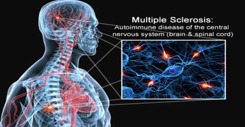 Symptoms and Treatments of Multiple Sclerosis