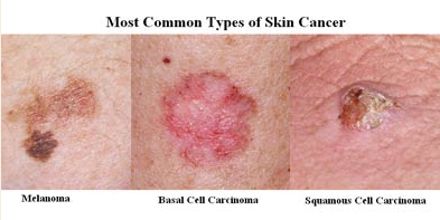 Symptoms and Treatments of Skin Cancer - Assignment Point