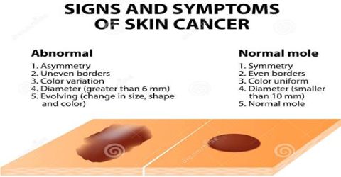 Symptoms and Treatments of Skin Cancer