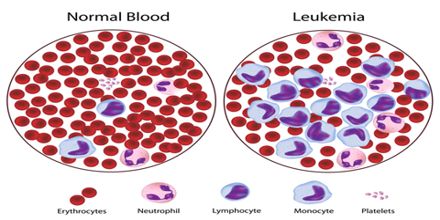 Symptoms and Treatment for Leukemia - Assignment Point