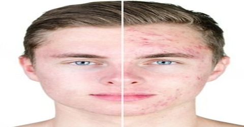 Acne: Skin Diseases