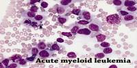 Acute Myeloid Leukemia: Causes, Symptoms and Treatment