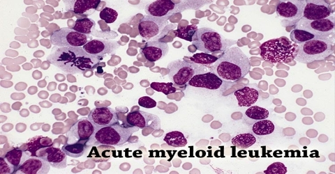 Acute Myeloid Leukemia: Causes, Symptoms and Treatment