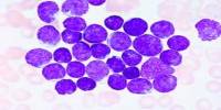 Acute Lymphocytic Leukemia: Causes, Symptoms and Treatment