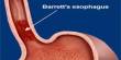 Barrett’s Esophagus: Causes and Treatment
