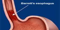 Barrett’s Esophagus: Causes and Treatment