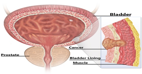 Bladder Cancer: Causes, Symptoms and Treatment