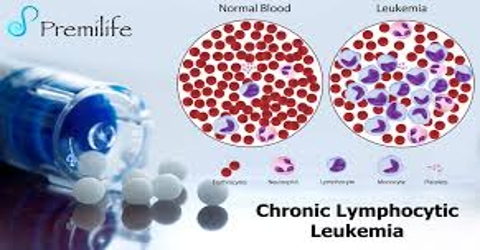 Chronic lymphocytic leukemia: Causes, Symptoms and Treatment
