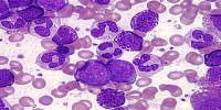 Chronic Myelogenous Leukemia: Causes, Symptoms and Treatment