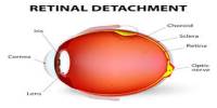 Retinal Detachment: Cause, Symptoms and Treatment