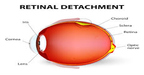 Retinal Detachment: Cause, Symptoms and Treatment