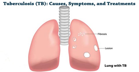 Tuberculosis (TB): Causes, Symptoms, and Treatments