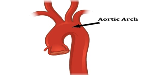 Aortic Arch