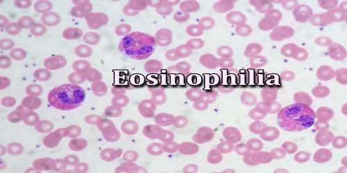 Eosinophilia