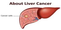 About Liver Cancer
