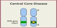 Central Core Disease