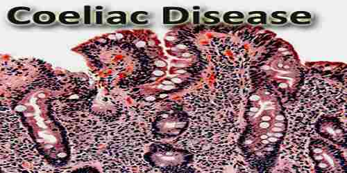 Coeliac Disease
