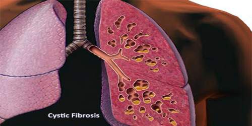 About Cystic Fibrosis