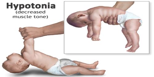 hypotonia muscle synergy