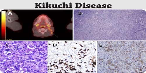 Kikuchi Disease