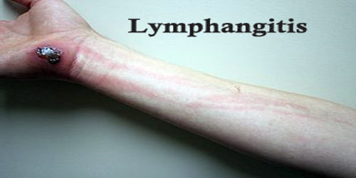 Lymphangitis
