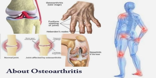 About Osteoarthritis