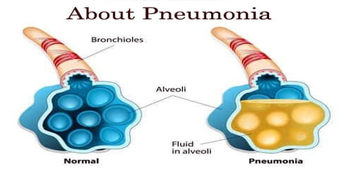 About Pneumonia