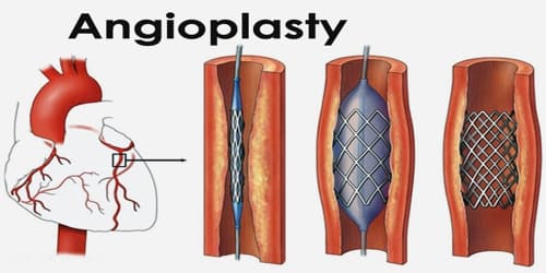 Angioplasty