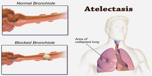 Atelectasis