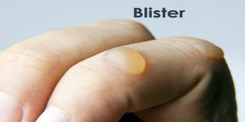 Blister