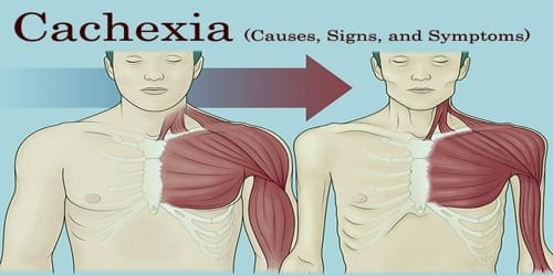 Cachexia (Causes, Signs, and Symptoms)