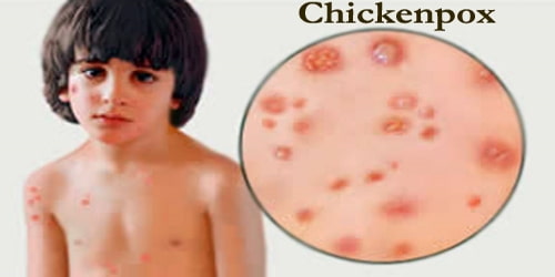 Chickenpox (Causes, Symptom, and Complications)