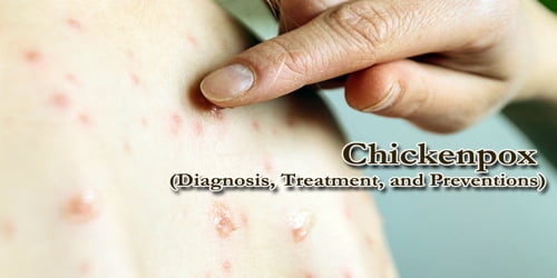 Chickenpox (Diagnosis, Treatment, and Preventions)
