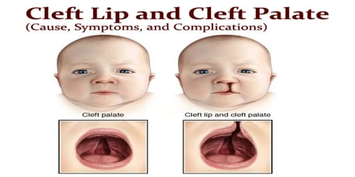 Cleft Lip and Cleft Palate (Cause, Symptoms, and Complications)