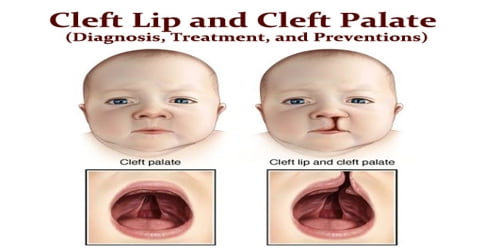 Cleft Lip and Cleft Palate (Diagnosis, Treatment, and Preventions)