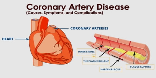 Coronary Artery Disease (Causes, Symptoms, and Complications)