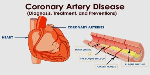 Coronary artery disease (Diagnosis, Treatment, and Preventions)