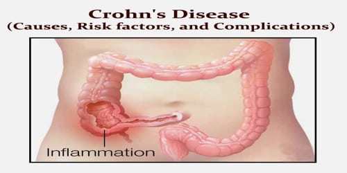 Crohn’s Disease (Causes, Risk factors, and Complications)