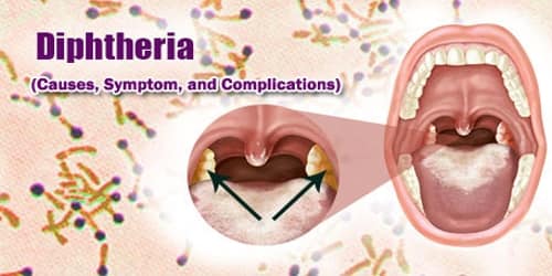 Diphtheria (Causes, Symptom, and Complications)
