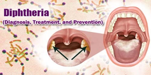 Diphtheria (Diagnosis, Treatment, and Prevention)
