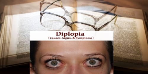 Diplopia (Causes, Signs, and Symptoms)