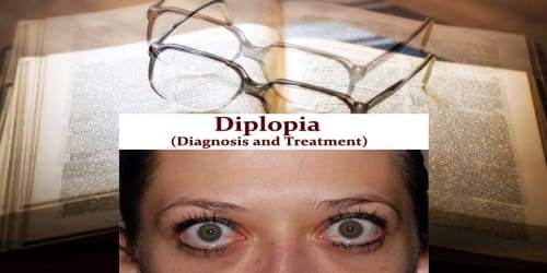 Diplopia (Diagnosis and Treatment)